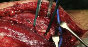Identification of the radial nerve and external brachial cutaneous branch.