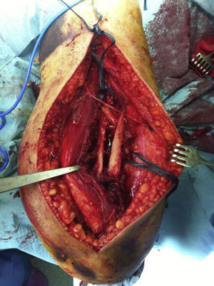 Fracture site with entrapped radial nerve.