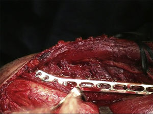 Distal plate extension in the external humeral column.