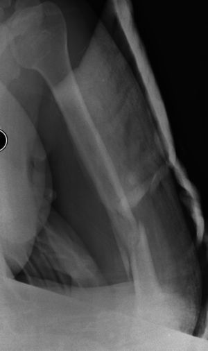 Extra-articular distal-third diaphyseal fracture of the humerus.