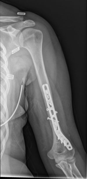 Result of X-ray 2 weeks after surgery.