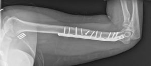 Result of X-ray one and a half months after surgery.
