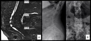 (A) Anteroposterior and lateral radiography of the lumbar spine showing interapophyseal degenerative changes of the L5-S1 space, and degenerative listhesis L4–L5. (B) MRI scan of the lumbar spine: major stenosis of the spine at three levels, essentially at level L4-L5 due to disc bulging, interapophyseal degenerative changes and hypertrophy of the yellow ligament.
