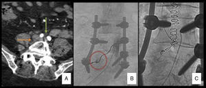 (A) Abdominal CAT with contrast; slice at the level of the L5 vertebral body L5. Green arrow: iliac arteries with contrast. Orange arrow: right paravertebral haematoma. (B) Arteriography: extravasation of contrast at the level of the right L5 lumbar artery suggestive of pseudoaneurysm. (C) Postembolisation arteriography: microcoils can be observed in the root of the L5 lumbar artery without the passage of contrast.