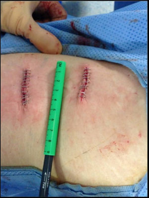 Two incisions for 4 lateral cages.