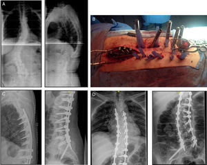 (A) Preoperative. (B) Intraoperative image. Hybrid technique. (C and D) Postoperative.