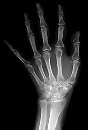 Preoperative posteroanterior radiography of left wrist; scaphotrapeziotrapezoid arthritis grade III according to the classification by Crosby et al.4
