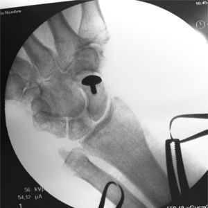 Intraoperative radiographic image confirming the appropriate placement of the implant.