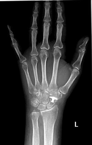 Postoperative posteroanterior radiography of the left wrist of 36 months’ evolution.