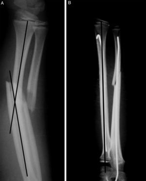 Pre- and postoperative radiographic measurement.