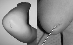 Insertion area of ulnar wire.
