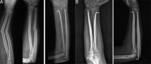 (A) Preoperative X-ray of child with fracture of radius and ulna. An immediate result with Kirchner wires can be seen. (B) Good radiological outcome with union and good alignment of radius and ulna.