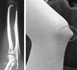 Good union and radiological alignment can be observed, but with a minor complication–proximal migration of the wire in the ulna–, resolved by removing the wire.