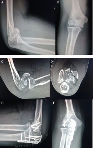 From left to right and from top to bottom: (A and B) lateral and AP X-ray images of the fracture. (C and D) CT images of the fracture. (E and F) Lateral and AP X-ray images of the osteosynthesis 6 days later.
