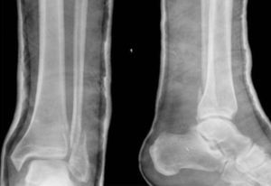 Case 5: Displaced fracture transverse to the syndesmosis with increased medial tibiotalar space.