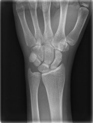 PA image of a scaphoid fracture.