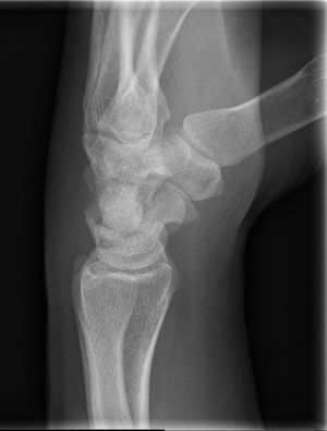 Lateral image of a scaphoid fracture.