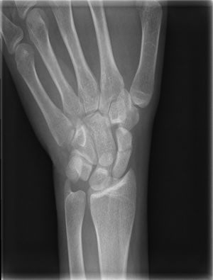 PA image of a scaphoid fracture with cubital deviation.