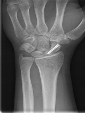 PA image of percutaneous osteosynthesis of scaphoid fracture.