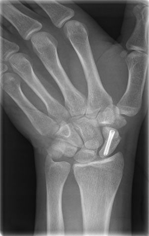 PA image with cubital deviation of percutaneous osteosynthesis of scaphoid fracture.