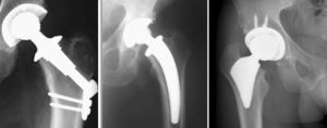X-ray appearance of types of short stem, according to Learmonth.64