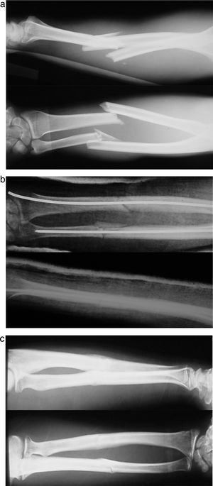 (a) Preoperative diaphyseal fracture X-ray of the radius and ulna. (b) Postoperative X-ray. (c) Check-up X-ray after 3 months.