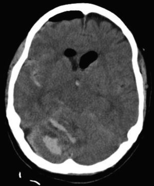 CT brain scan slice after occipital craniotomy. Greater mass effect on the IV ventricle and mesencephalon. Greater hyperdensity in the longitudinal and transverse sinuses.