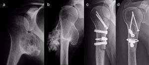 PEH osteochondroma in a 40 year-old woman with the suspicion of malignisation. The radiographic change from 1999 (a) to 2011 (b) is visible. Postoperative radiographic imaging tests (c) and 4 years later, with remodelling of the homograft (d).