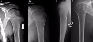 Osteochondromas of the proximal end of the humerus in a 7 year-old boy (black arrow [a]) and in an 11 year-old girl (outlined arrow [c]), with spontaneous regression 1 and 2 years later, respectively. Radiographic imaging tests 2 and 6 years later (b and d).