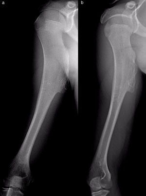 Proximal sessile metaphyseal osteochondroma of the humerus in a 13 year-old male: AP radiographic imaging test in 2014 (a) and one year later (b). He is currently still asymptomatic and under observation.