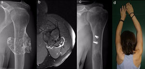 Sessile osteochondroma (a) in a 36 year-old woman, implanted in the posterior face of the humerus and occupying half of its circumference, with a chondral cap less than 3mm thick (b). Radiographic imaging (c) and clinical test (d) one year after surgery.