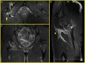 MR images on axial (a), sagittal (b) and coronal (c) planes, showing: changes in the ischiofemoral space with oedema of the quadratus femoris muscle on (a, b, and c) (asterisk). Increased perifascial signal between the flexor and adductor muscles on (a and b) (tip of arrow). Increased perineural signal in sciatic nerve on a (arrow). IFS (lines 18.3mm and QFS (dots) 12.6mm. The unaffected contralateral side measurement was IFS 19.4mm and QFS 14.1mm.