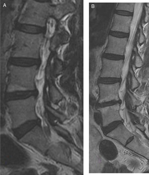 A) enhanced sagittal image in T2 of lumbar MRI of a woman aged 45 where Modic type 1 change is found in the vertebral end plate below vertebra L4. B) Image of enhanced sagittal slice in T2 of lumbar MRI of the same patient after 10 years where we observe Modic type 1 change in vertebral end plate below vertebra L4 and in vertebral endplate above L5. The patient did not require surgical treatment nor occupational disability.