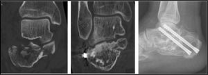 Progression of Sanders type IV fracture to a subtalar arthrodesis following primary osteosynthesis.