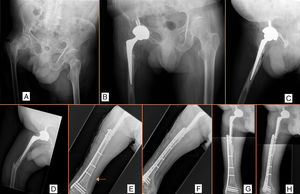 Neck of the femur fracture treated with total hip replacement with intraoperative instability (A–C). Periprosthetic fracture treated with plate (D–H). Intraoperative iatrogenic fracture (E, arrow).