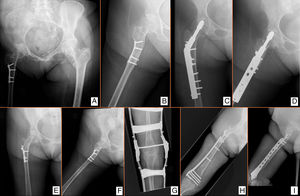 Petrochanteric fracture (A, B). The problems observed were: deformity secondary to osteotomy of the proximal femur (B, I), presence of an implant (A, B), suprachondylar osteotomy (G), and osteoporosis (A), small bone (observe over dimension of the implant) (C, D, H, I). Posterior suprachondylar fracture (G–I).