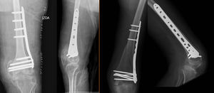Left: over-sized standard distal plate of the femur. Right: suprachondylar fracture is fixed with a precontoured 3.5 locking plate of the distal tibia, which matches the bone size perfectly.