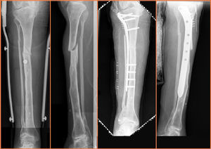Observe the deformed bone due to previous fractures, the narrow canal, which did not allow for the use of an intramedullary screw and the over sized plate compared with the bone size.