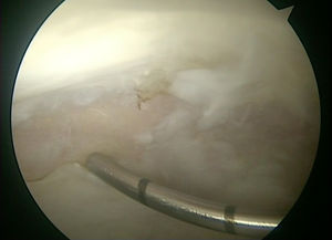 Intraoperative image of the right hip from the anterolateral portal. Measurement of the size of chondral damage with an instrument inserted through the medioanterior portal. The space between the marks is 5mm.