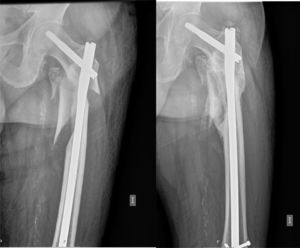 78-year-old male. Put into the poor reduction group. Note collapse and union at 9 months. Symptoms of limping and moderate pain.