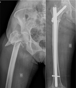 80-year-old woman. Put into the good reduction group with opening of focus fracture.