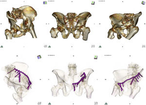 Top: CAT imaging after carrying out volume rendering showing Judet projections (wing, anteroposterior and obturator) in anterior spine fracture and quadrilateral plate of left acetabulum. Bottom: after 16-bit rendering of the postoperative CAT scan total contact of the plate was observed which neutralised the anterior spine and partial contact with the surface of the quadrilateral plate.