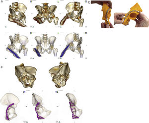 (a) Top: CAT imaging after volume rendering showing Judet projections (obturator, anteroposterior and wing) in patient with posterior hip luxation and fracture of the right acetabular posterior wall. The patient had a diaphyseal nail in the right femur due to previous trauma. Bottom: the same projection with 16-bit rendering, where to show the relationship between the nail and the fracture, the transparency of the layer representing bony values was increased and the opaqueness of the layer representing the values corresponding to the metal was increased. (b) Printed model of the right acetabulum obtained after specular inversion of the healthy hemipelvis, left, and its segmentation, over which the final osteosynthesis plate has been adapted to neutralise the posterior wall. As no intermediate sizes were available, the selected plate was extended very distally over the ischium surface. (c) Top: CAT images after volume rendering and segmentation of the femoral head of both hemipelvis. Anatomical reduction of the fracture was observed compared to the healthy acetabulum. Bottom: total contact of the osteosynthese plate in Judet projections after segmentation and 16-bit volume rendering.