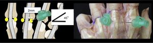 Metacarpophalangeal portal development. Recess areas are located at approximately 2mm from both sides of the extensor tendon. Initial orientation has to be at 45° or towards mid-line.