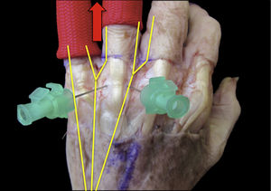 Traction for arthroscopy of the fourth and fifth fingers. The common cubital trunk which innervates DU4 and DR5 is therefore centred on the traction axis, enabling the mid-line nerves to be moved away and therefore away from the metacarpophalangeal portals.