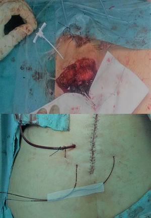 Image of the catheters. Includes the introducer when past the muscular place and the final image before covering with the dressings.
