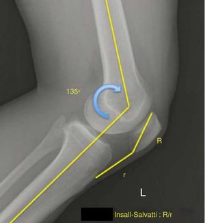 The Insall-Salvati index is the ration measured and evaluated at 45° radiologically in flexion, the ratio is established between the patella (P) and the patellar tendon length (r).