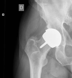 MoM hip arthroplasty implanted 13 years previously. Normal blood metal levels. Asymptomatic patient.