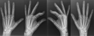 Patient B: posteroanterior and oblique X-ray images of both hands of the mother of patient A, showing bilateral carpal scaphoid–trapezium coalition in different degrees.