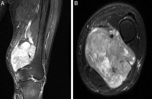 Preoperative MRI, gadolinium-enhanced T2 sequences. Vascular LMS at distal thigh level, extra-articular, surrounding the superficial femoral vein. (A) Coronal slice. (B) Transverse slice.